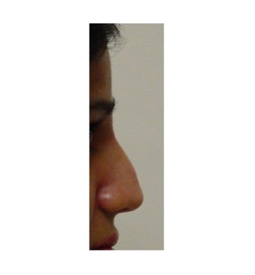 Establishing Balance Through Rhinoplasty Before